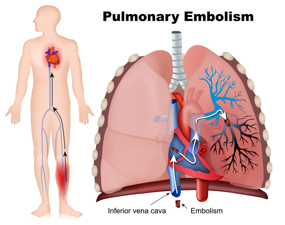 ภาวะที่มีลิ่มเลือดไปอุดตันหลอดเลือดแดงในปอด