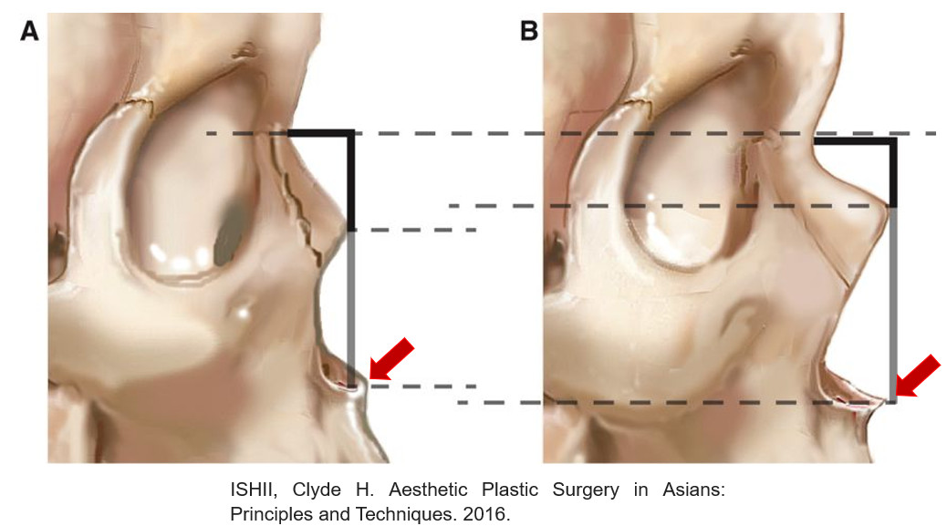 กระดูกจมูกของคนเอเชีย จะสั้นและต่ำกว่ากระดูกจมูกของฝรั่งทางด้านขวา