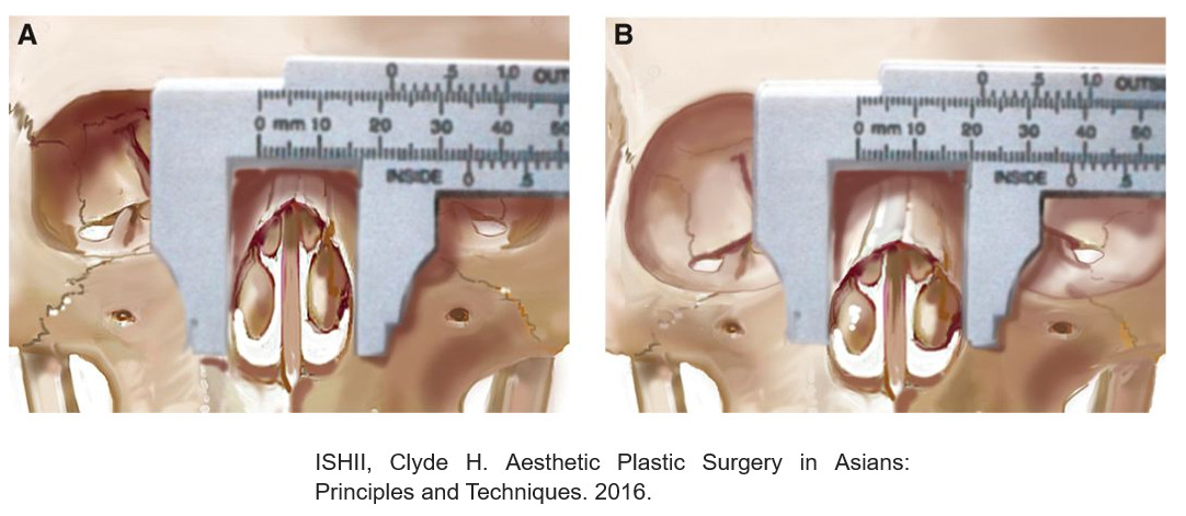 กระดูกบริเวณรอบรูจมูก ของคนเอเชียจะมีลักษณะที่กว้างกว่าของฝรั่ง