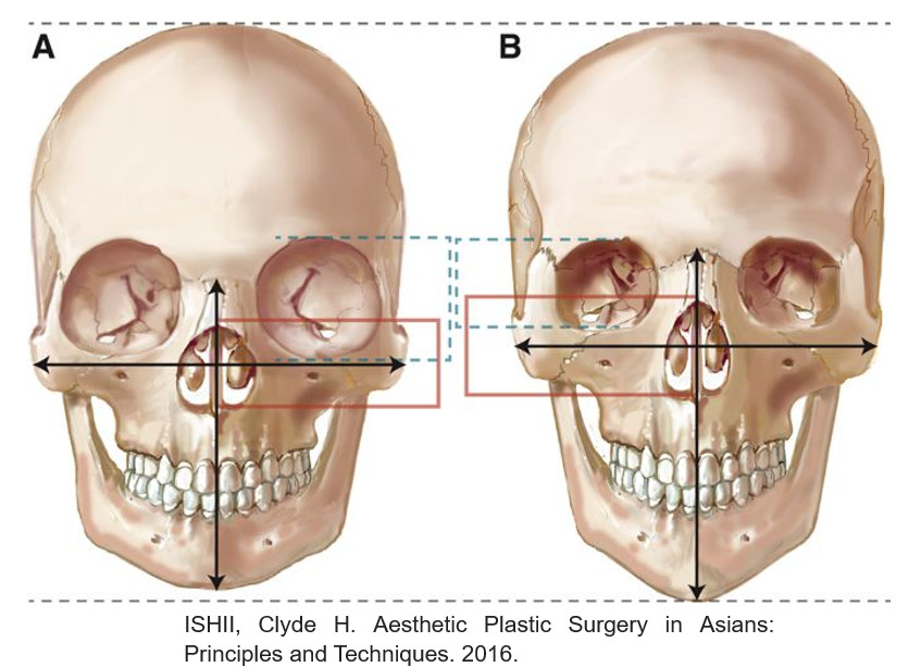 คนเอเชียจะมีใบหน้าที่สั้นและกว้าง ส่วนฝรั่งจะมีใบหน้าที่ยาวและแคบ