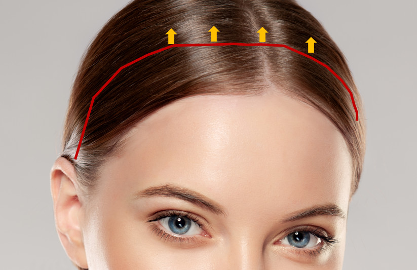 การตัดหนังหลังแนวไรผม หรือ coronal brow lift