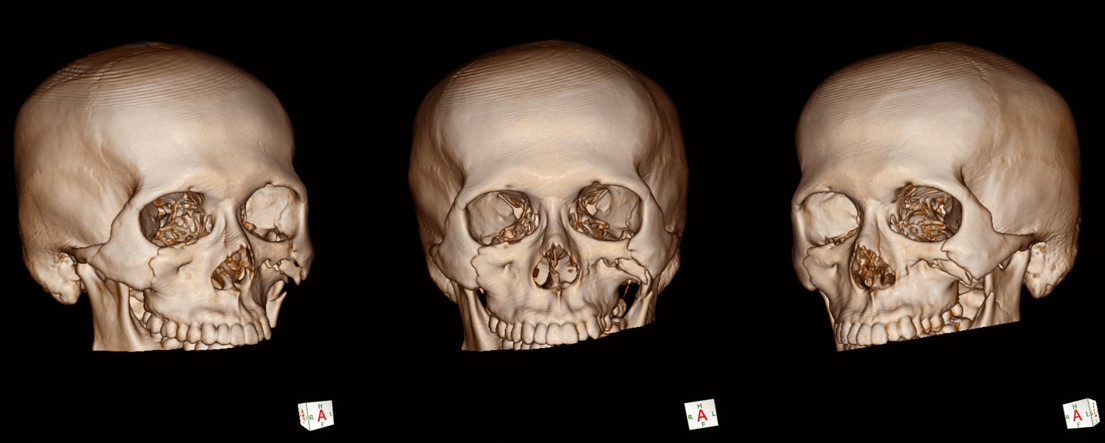ภาพ 3 มิติ ที่ได้มาจากการทำ CT scan