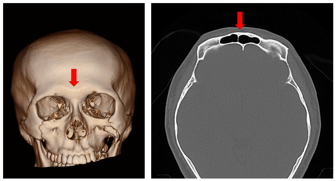 โพรงนี้มีชื่อเรียกว่า frontal sinus 