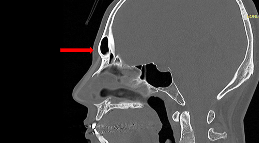 ความโหนกนูนของหนาผากส่วนนี้เกิดจากรูปร่างของโพรง frontal sinus 