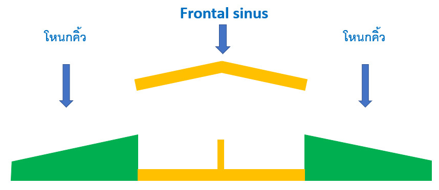 ตัดผนังด้านหน้าของ frontal sinus ออกมา 