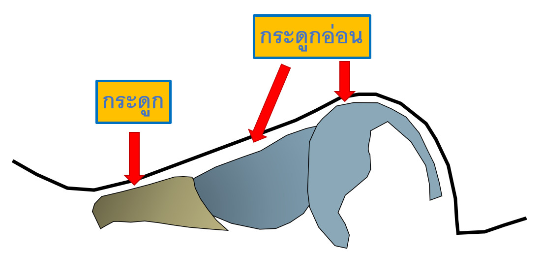 ซิลิโคนเสริมตลอดความยาวจมูก