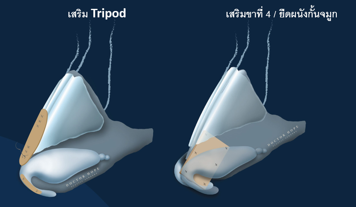 เสริมปลายจมูกจะใช้วิธีการที่เรียกว่า tip plasty