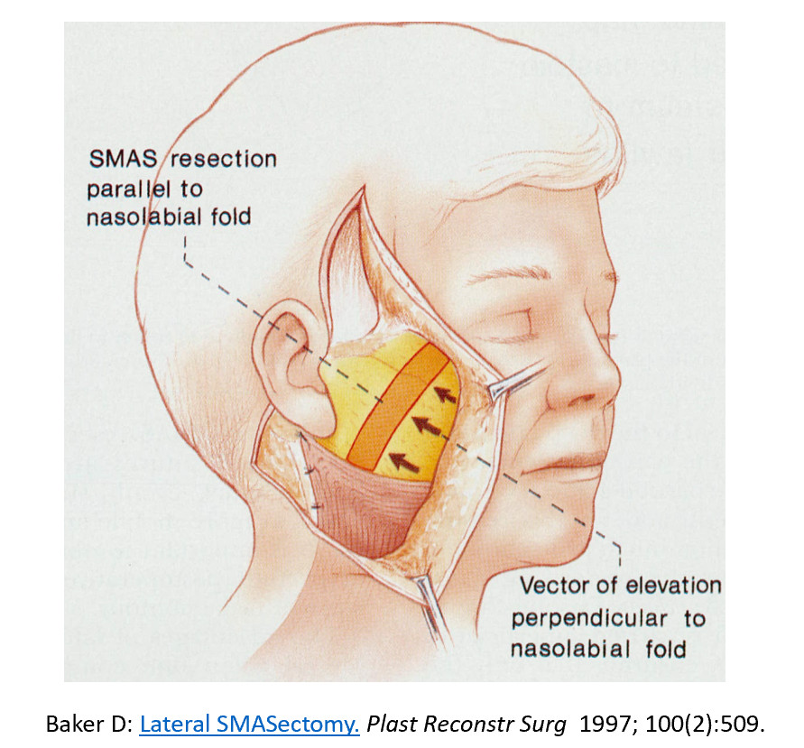 วิธีตัด SMAS ออกมาเป็นแถบแล้วเย็บขอบที่ตัดเข้าหากันทำให้ดึง SMAS ขึ้นมาได้
