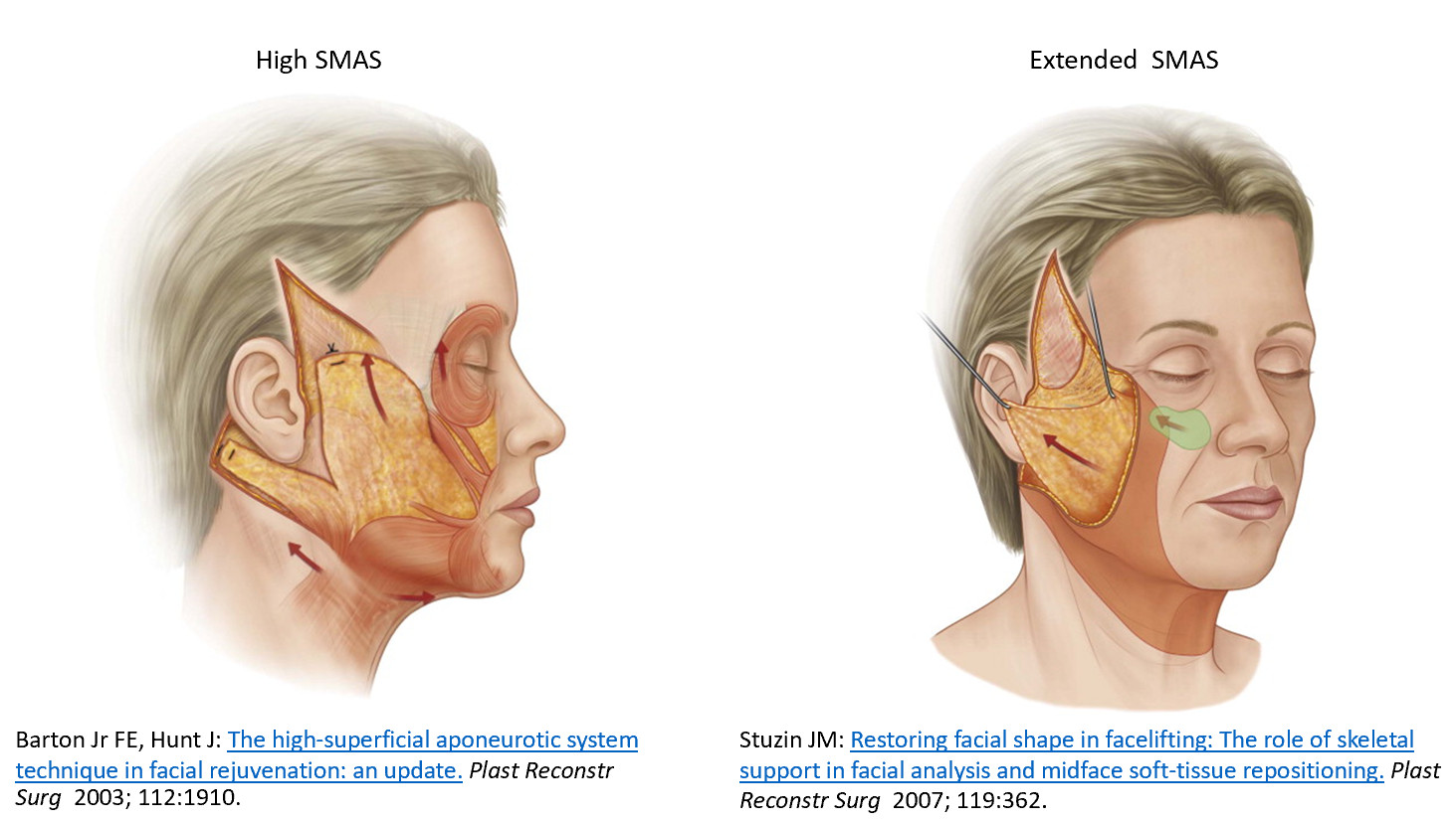 การดึงชั้น SMAS โดยมีการเลาะไปใต้ชั้น SMAS ทำให้มีการตัด ligament ใต้
